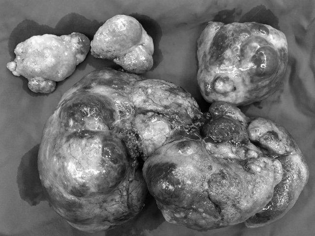 Người phụ nữ Sài Gòn mang khối u hiếm gặp nặng hơn 3 kg-1