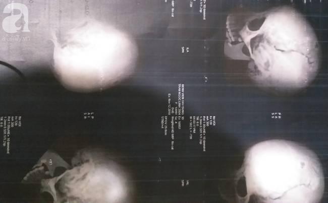 Nữ sinh lớp 9 ở Hà Nội tố bị vợ hai của bố đập đầu, đánh tới mức phải nhập viện-2