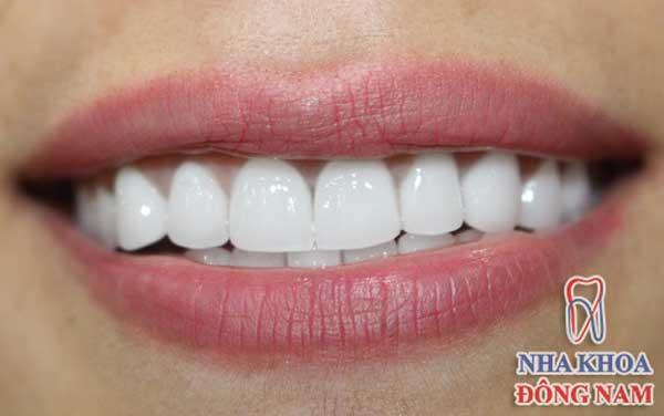 Làm răng đẹp chỉ trong 3 ngày-1