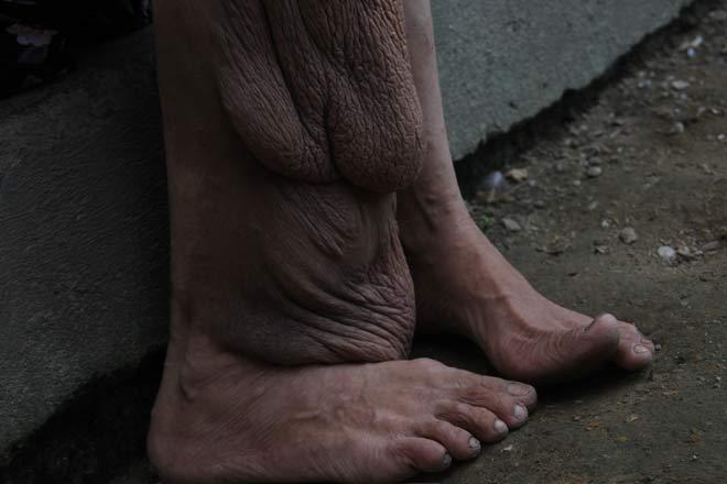 Cảm động chuyện tình rổ rá giữa cô nàng chân voi và anh chàng mù-2