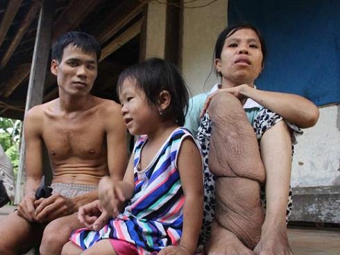 Cảm động chuyện tình 'rổ rá' giữa cô nàng 'chân voi' và anh chàng mù