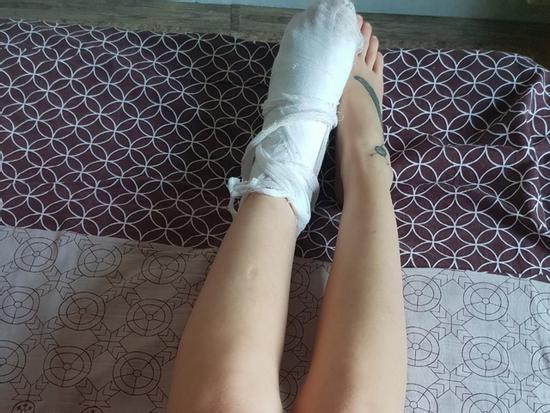 Cô gái mặc bikini nóng bỏng bị gẫy chân vì dại dột nhảy xuống hồ nước đóng băng