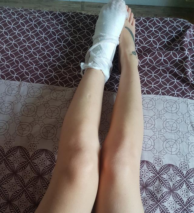 Cô gái mặc bikini nóng bỏng bị gẫy chân vì dại dột nhảy xuống hồ nước đóng băng-3