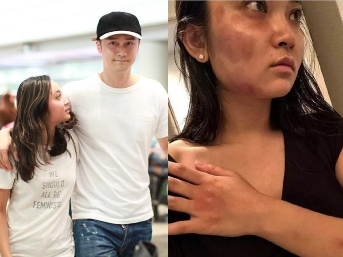 Bạn gái ngôi sao Bộ bộ kinh tình tố bị người tình vũ phu, đánh đập đến sảy thai-7