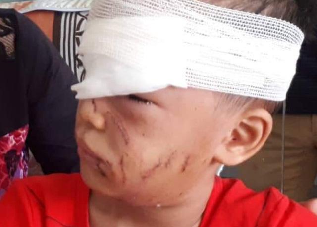 Thanh Hóa: Kinh hoàng bé trai 6 tuổi bị chó nhà cắn rách mặt-2