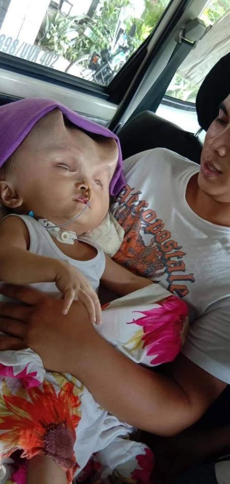 Em bé 1 tuổi mang cặp sừng quỷ dữ sau ca phẫu thuật bất thành-2
