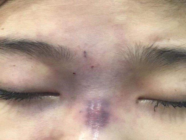 Cô gái ở TP.HCM mù mắt sau khi bạn trai tự tay tiêm filler nâng mũi-1