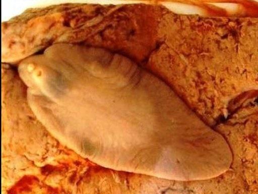 Sán nhái 7cm nằm trong não người đàn ông-3