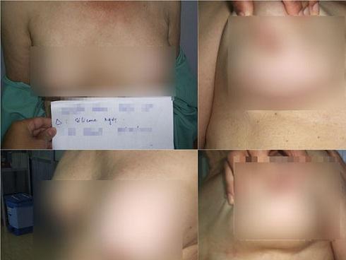 Những biến chứng kinh hoàng từ việc tiêm chất làm đầy dạo-2