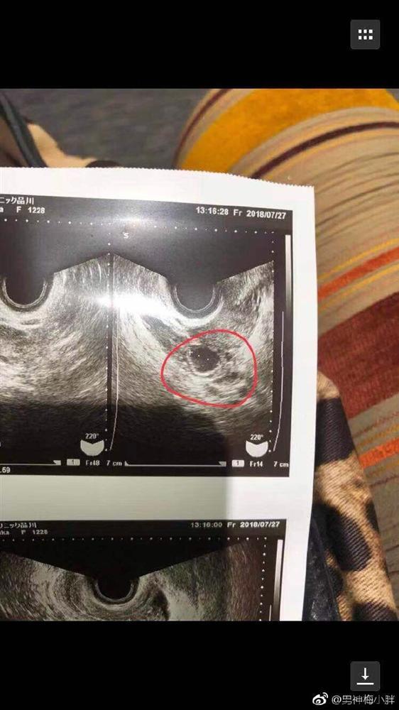 Bạn gái ngôi sao Bộ bộ kinh tình tố bị người tình vũ phu, đánh đập đến sảy thai-3