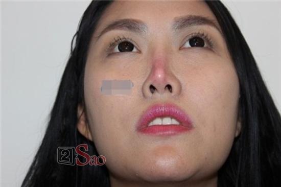 Trấn Thành khoe tóc mới nhưng fan lại khuyên đi sửa lại mũi vì nhìn lệch quá lệch-8