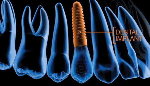 Trồng răng Implant hiện đại ở Nha khoa Đông Nam-1