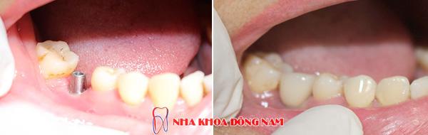 Trồng răng Implant hiện đại ở Nha khoa Đông Nam-2