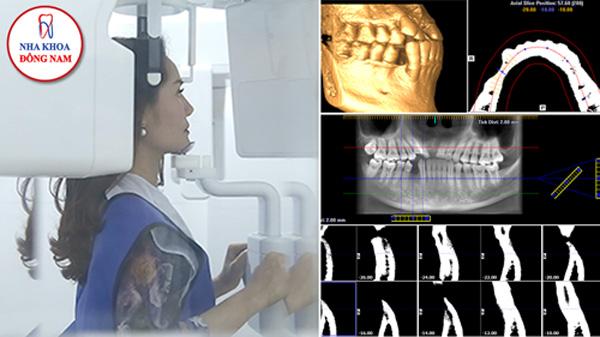 Trồng răng Implant hiện đại ở Nha khoa Đông Nam-3