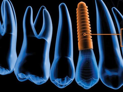 Trồng răng Implant hiện đại ở Nha khoa Đông Nam