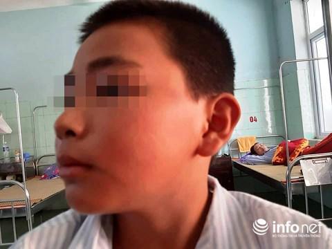 Cậu bé Quảng Bình sợ hãi kể lại giây phút bị cô giáo phạt 231 cái tát đến nhập viện-2