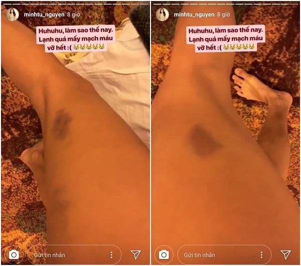 Minh Tú bị vỡ mạch máu, đôi chân đang nuột nà giờ đây bầm dập tại Miss Supranational 2018-1