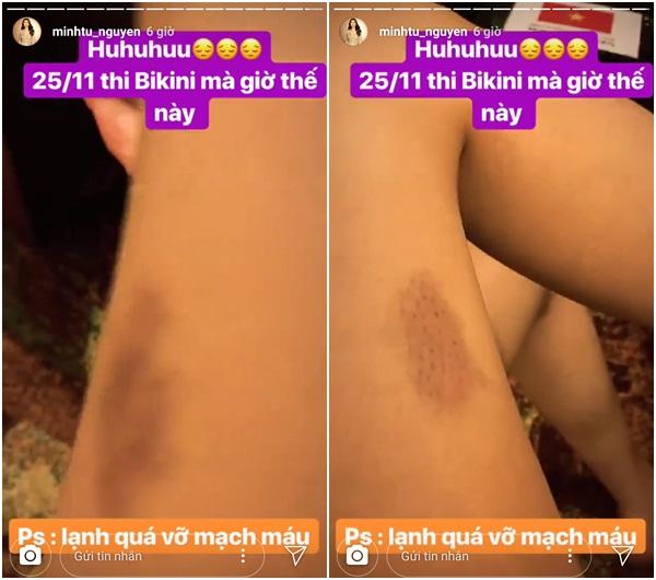 Minh Tú bị vỡ mạch máu, đôi chân đang nuột nà giờ đây bầm dập tại Miss Supranational 2018-2