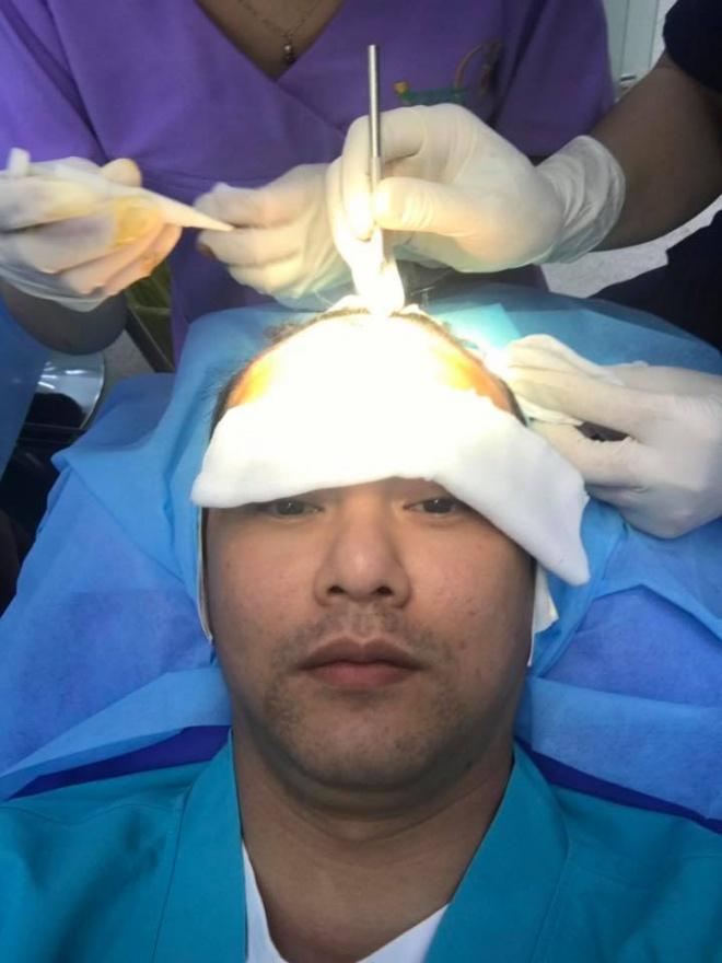 Bị hói, ca sĩ Ưng Đại Vệ quyết định cấy 2000 sợi tóc-6