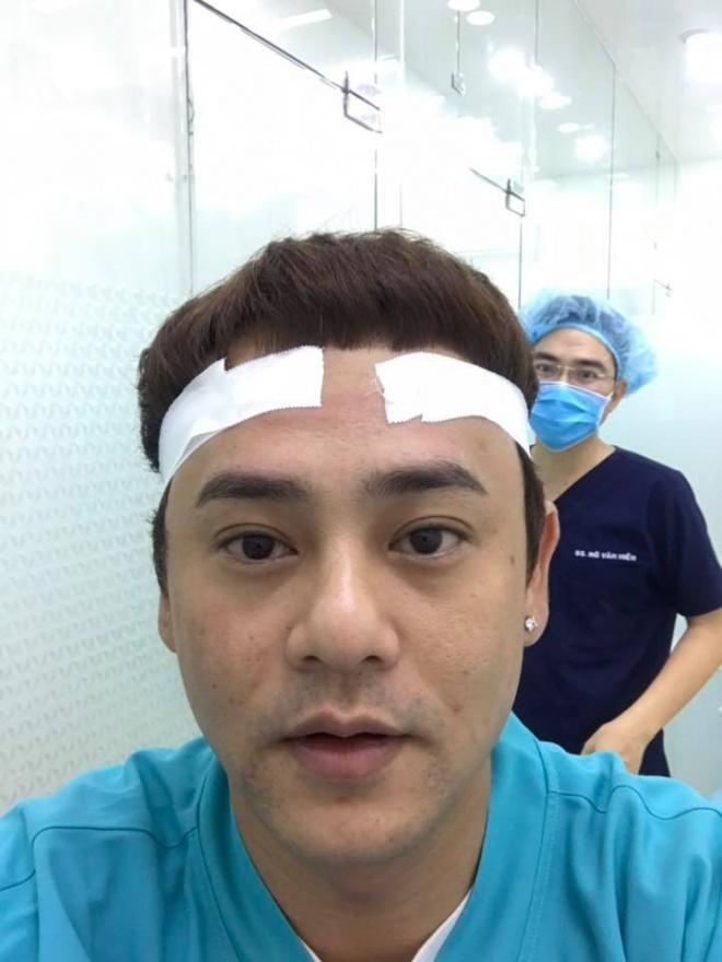 Bị hói, ca sĩ Ưng Đại Vệ quyết định cấy 2000 sợi tóc-7