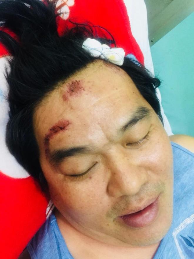 Nghệ sĩ Hoàng Mập bị tai nạn giao thông, thương tích khắp người-3
