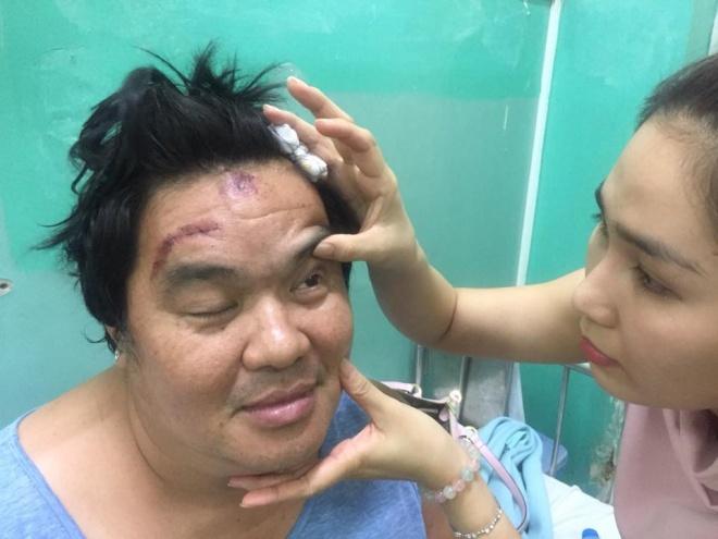 Nghệ sĩ Hoàng Mập bị tai nạn giao thông, thương tích khắp người-8