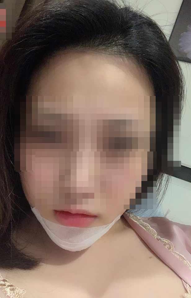 Shock: Tiêm filler kém chất lượng, gái xinh lên bà n phẫu thuáºt nạo 4 lần vẫn chưa hết tạp chất trên mặt-1