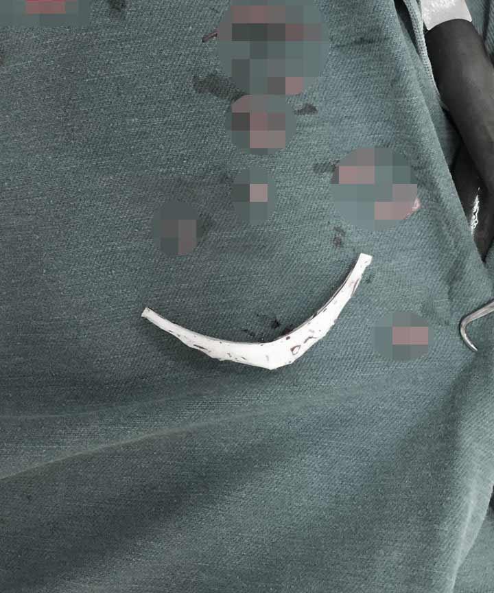 Tiêm filler kém chất lượng, gái xinh lên mạng cầu cứu vì cằm bị biến dạng-2