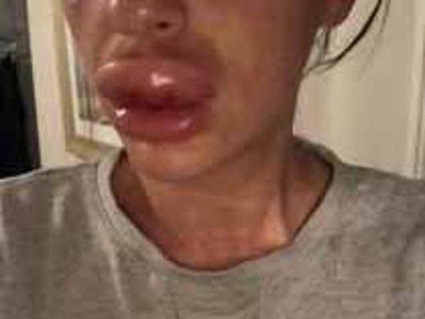 Tiêm botox tại nhà, đôi môi của cô gái trẻ sưng gấp 4 lần bình thường-2