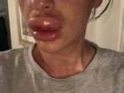 Cô gái suýt phải cắt bỏ môi vì theo đuổi trào lưu tiêm botox