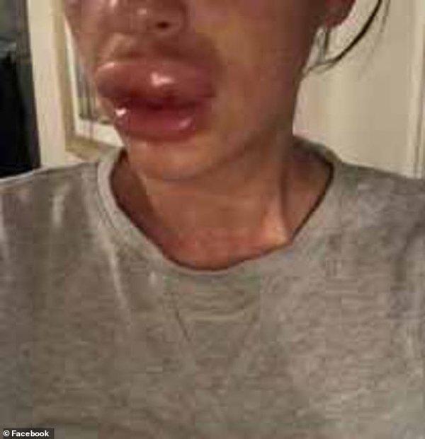 Cô gái suýt phải cắt bỏ môi vì theo đuổi trào lưu tiêm botox-2