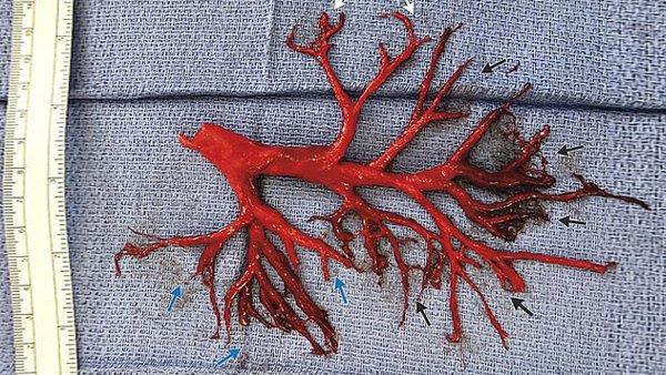 Hãi hùng: Người đàn ông nôn ra cả cây phế quản sau khi ho quá nhiều-1