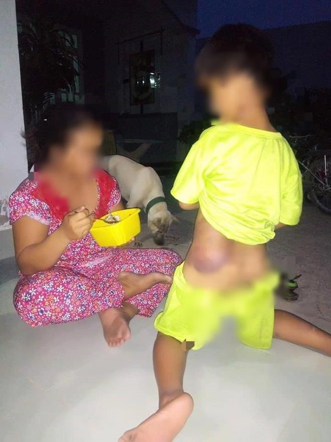 Long An: Bé trai khuyết tật 7 tuổi bị cô giáo đánh bầm tím cả cơ thể-1