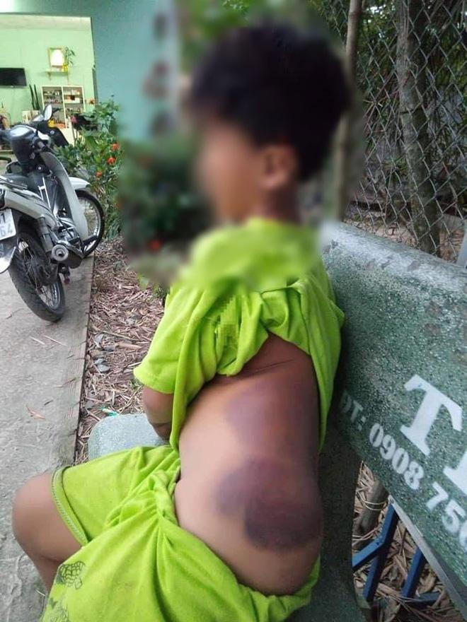 Long An: Bé trai khuyết tật 7 tuổi bị cô giáo đánh bầm tím cả cơ thể-2