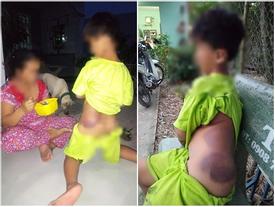 Long An: Bé trai khuyết tật 7 tuổi bị cô giáo đánh bầm tím cả cơ thể Long An: Bé trai khuyết tật 7 tuổi bị cô giáo đánh bầm tím cả cơ thể
