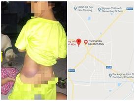 Đình chỉ công tác giáo viên đánh học sinh bầm tím người Đình chỉ công tác giáo viên đánh học sinh bầm tím người