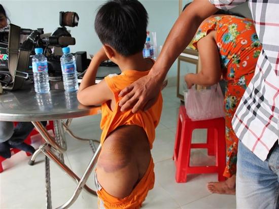 Vụ giáo viên đánh học sinh bầm mông: Do mẹ học sinh... nhờ đánh