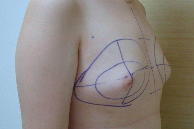 Nam thanh niên ngực bỗng to lên mỗi ngày vì dùng ké mỹ phẩm của bạn gái-1