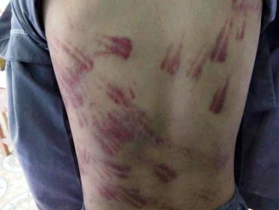 Thanh Hóa: Cháu bé mồ côi bị sư thầy đánh bầm tím khắp cơ thể