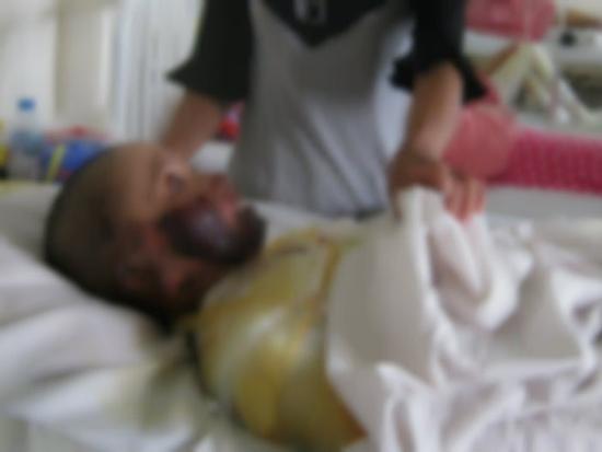 Thai phụ bỏng nặng, mất con vì treo xăng ở trong bếp