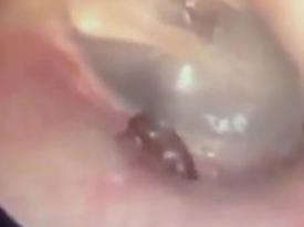 Rùng mình cảnh bác sĩ bắt kiến kiếm ăn trong… tai bệnh nhân Rùng mình cảnh bác sĩ bắt kiến kiếm ăn trong… tai bệnh nhân