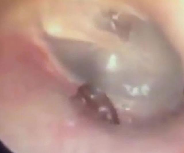 Rùng mình cảnh bác sĩ bắt kiến kiếm ăn trong… tai bệnh nhân-1