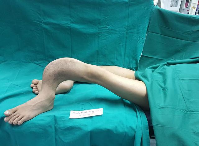 Kéo dài đôi chân cong như rễ cây giúp Hoàng tử ếch đi lại được sau 28 năm-1