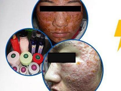 Bí kíp xử đẹp 4 loại mụn đáng ghét một cách thần tốc ai cũng làm được-6