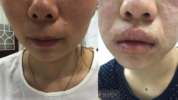 Rùng mình gương mặt như mảng cơm cháy của nữ sinh 19 tuổi sau chữa mụn tại spa-3