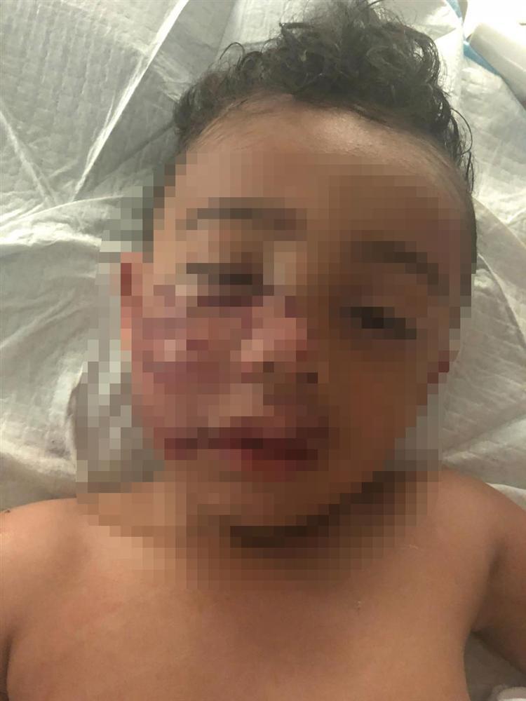 Mẹ kể lại giây phút con trai bị chó pitbull cắn nát khuôn mặt trong đau đớn-1