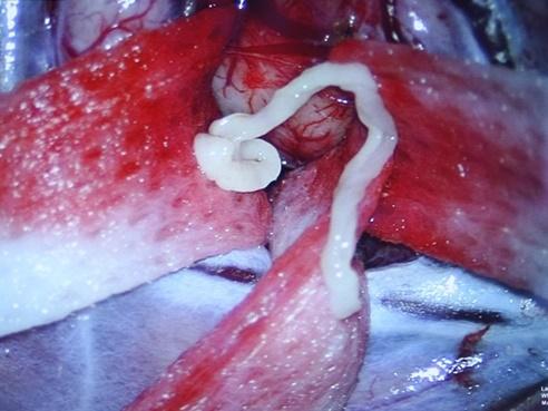 Mê tiết canh, nam thanh niên bị sán làm tổ to trong não-2