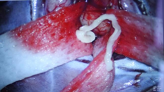Sán nhái 7cm nằm trong não người đàn ông-2