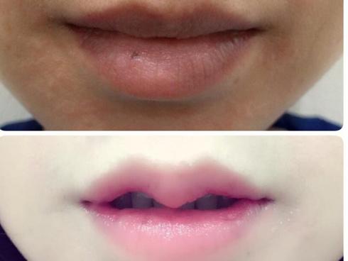 Đi cắt môi trái tim và kết quả là mồm như cửa không cánh-5