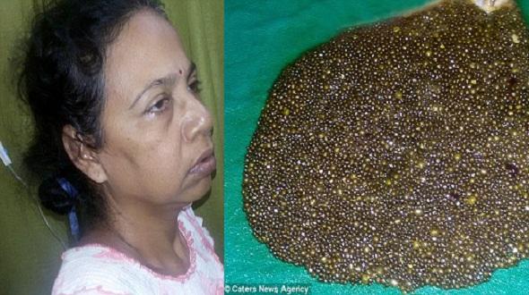 Bác sĩ BV E hoảng hốt nhặt bát sỏi gần 400 viên trong mật người phụ nữ-2